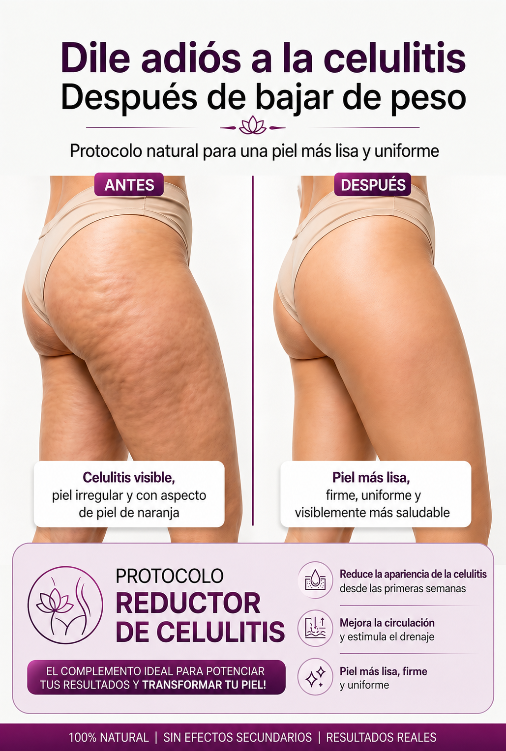 Antes y Después de la Celulitis
